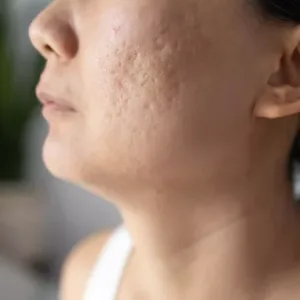 Microneedling treatment in Novi, MI