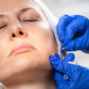 Aesthetic Medicine Facial Contouring with 3D Meso Threads.